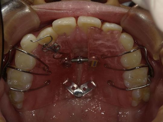 歯科矯正学 マウスピース矯正 - 医療法人しみず歯科 グランデンタルクリニック