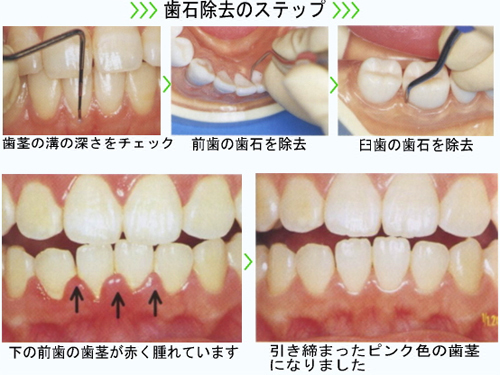 予防歯科とは 医療法人しみず歯科 グランデンタルクリニック 岡山県岡山市